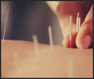 acupunctura efecte ciudate care nu sunt efecte adverse