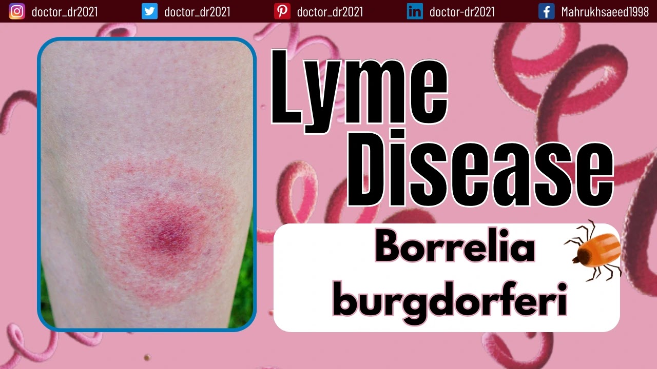 Borrelia burgdorferi: A Closer Look at Lyme Disease