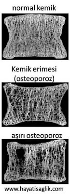 kemik erimesi osteoporoz