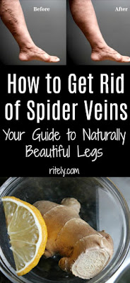 How To Get Rid of Spider Veins: Your Guide To Naturally Beautiful Legs!!!