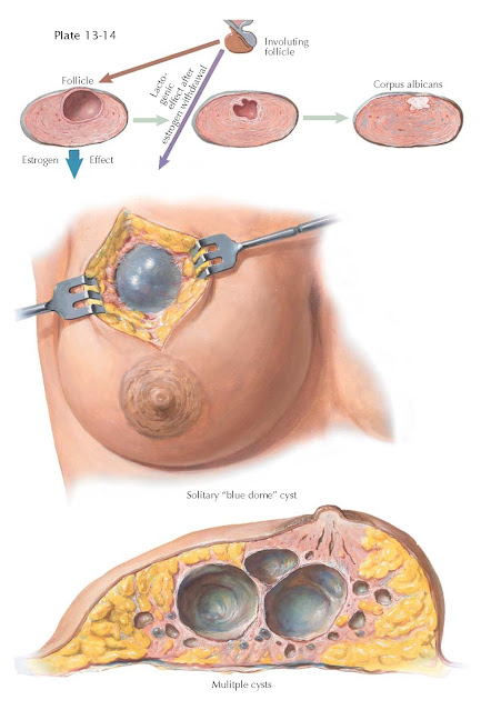 FIBROCYSTIC CHANGE III— CYSTIC CHANGE