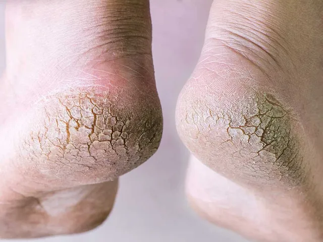 What to do if the foot is cracked
