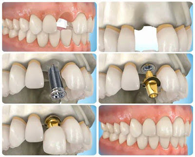 Một số điểm cần lưu ý khi cấy ghép implant