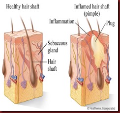 hair-shaft healthy and inflamed