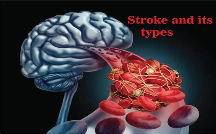 What is Stroke and What are its Different Types?