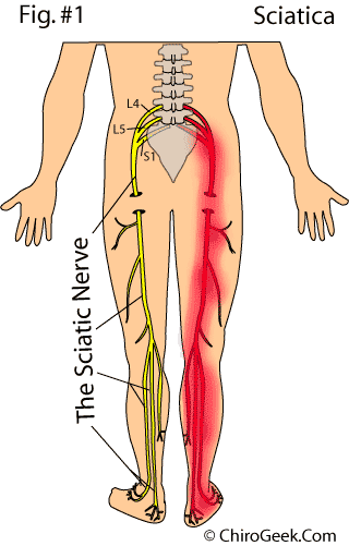 MAKLUMAT KESIHATAN DAN PENYAKIT: Sakit Saraf Sciatica 1 