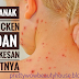 TIP JAGA ANAK KENA CHICKEN POX DAN CARA MERAWAT CHICKEN POX DENGAN BERKESAN