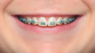 http://www.clinicadentalacedomartin.es/tratamientos/ortodoncias/