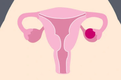 ichhori_ovarian cyst