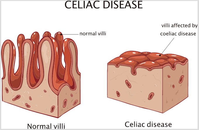 Natural remedies for Celiac disease.