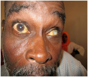 Glaucoma patient requires eye drops