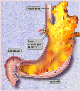 Common Signs and Symptoms of Stomach Indigestion