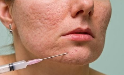 How To Get Rid Of Red Acne Marks