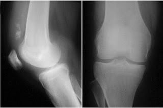 condrosarcoma