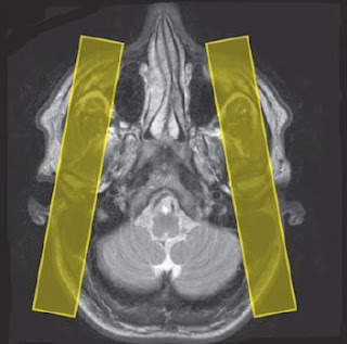 TMJ MRI