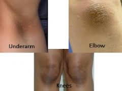 Tips To Get Rid Of Black Knees And Elbow