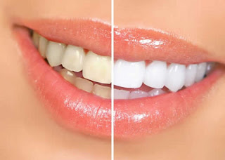 RECEITAS CASEIRAS PARA BRANQUEAR OS DENTES