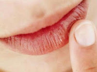8 Cara Cegah Bibir Pecah-pecah Saat Berpuasa