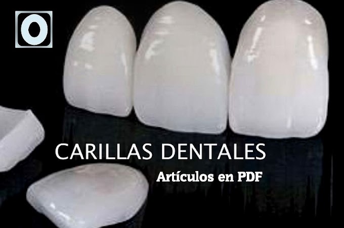 6 ARTÍCULOS de CARILLAS DENTALES en PDF que debes leer y compartir