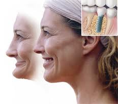 Chicago dental implants