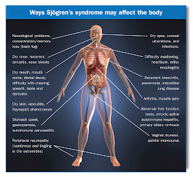 Courtesy of the Sjogren's Syndrome Foundation