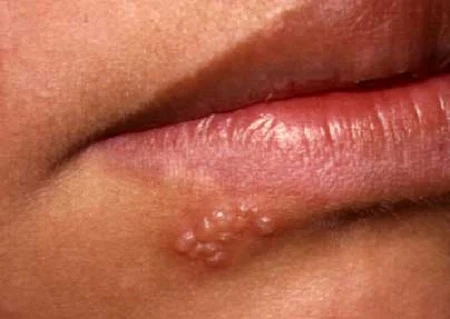 Herpes Labialis icd 10