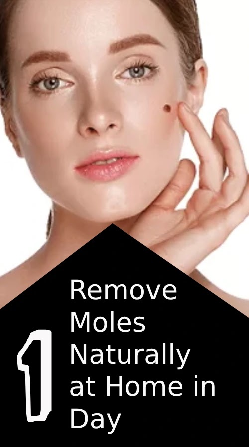 Easy Way to Remove Moles Naturally at Home in One Day