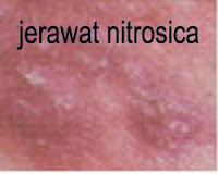 jerawat nitrosica