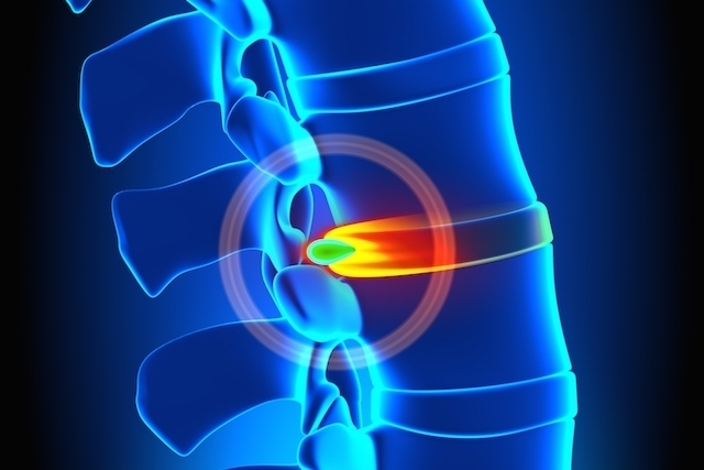 Endoscopia terapêutica e a Hérnia de Disco