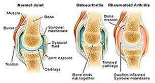 osteoarthritis of the knee