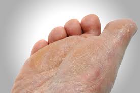 Common Problems of the Feet