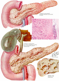 Pancreatite é coisa séria