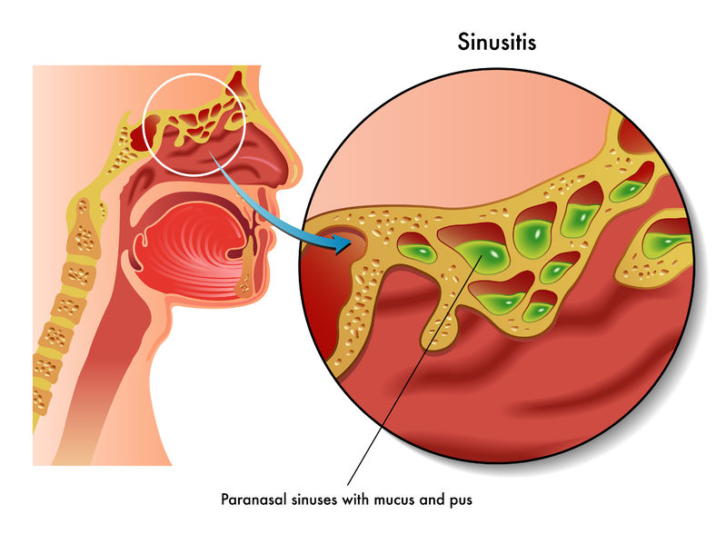 Terapi Gurah Bisa Mengobati Sinusitis