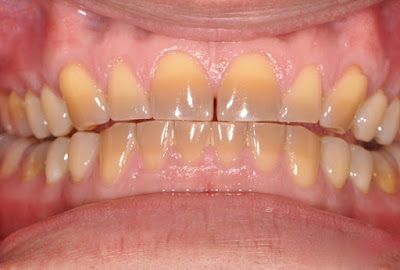 Nguyên nhân răng nhiễm tetracycline