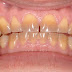 Răng bị nhiễm Tetracycline thì phải làm sao?