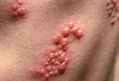 herpes cold sores fever blisters