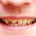 Răng hàm thì có nên bọc sứ không?