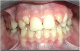 7. Anomalie de forme et de structure et de position des deuxlatérales :