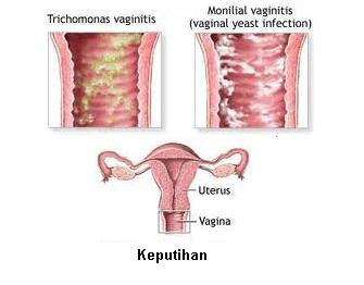 penyebab keputihan