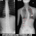 脊椎側彎矯正案例24-二個月胸椎側彎44度降至31度