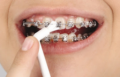  Niềng răng ảnh hưởng đến sức khỏe khi nào?