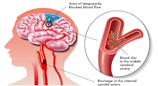definisi penyakit stroke