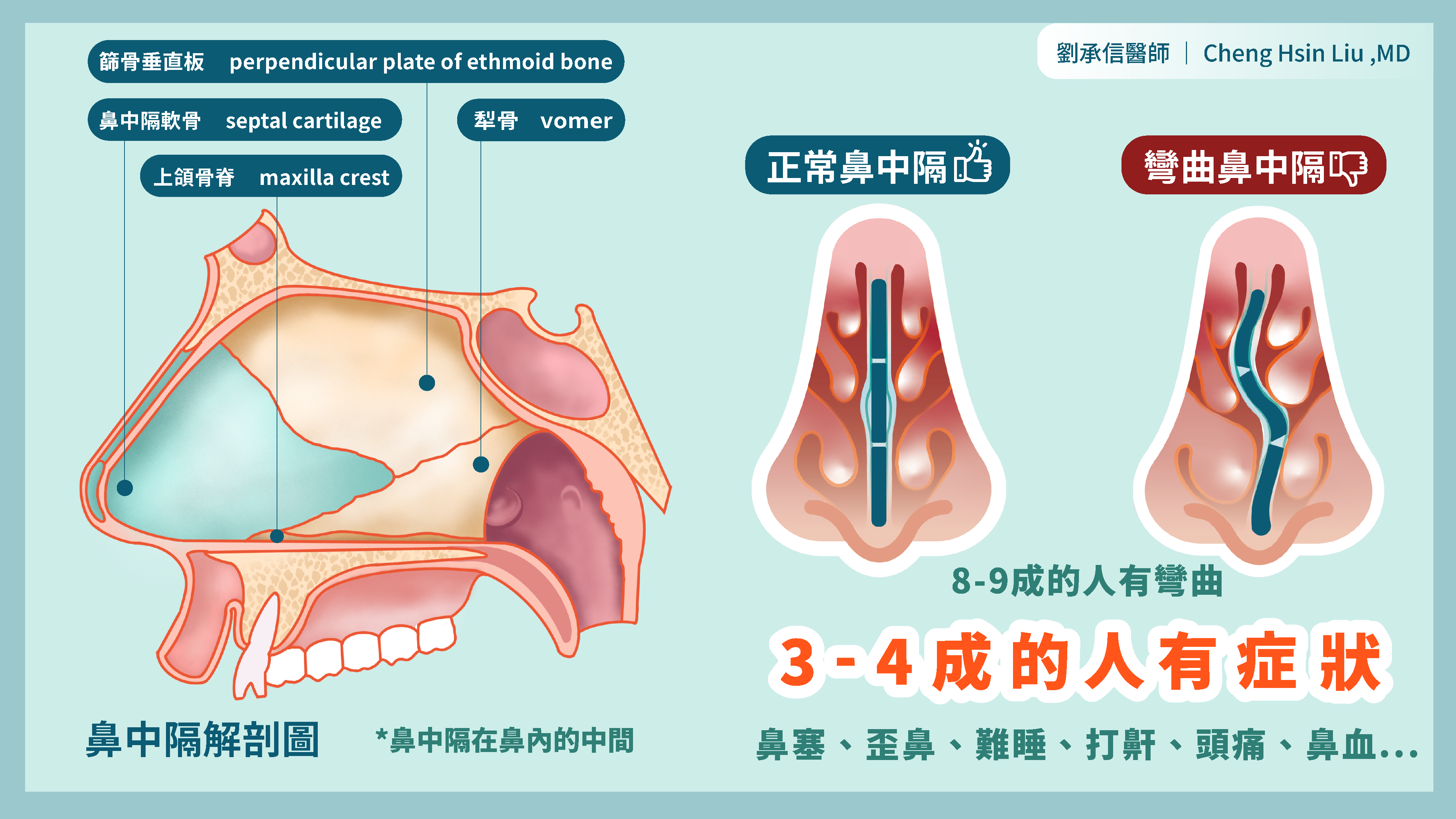 鼻中隔(Nasal septum)，位於鼻內的中央，有如分隔島一般，在呼吸時能夠讓空氣順暢地被調節導引進入肺部。鼻中隔約有1-2mm厚，前下段是有彈性的軟骨、後上段則是由硬骨組成；從正面看過去會像是沙漏的形狀，上下較寬、中央較窄。  而鼻中隔彎曲(Deviated nasal septum)最常見的原因是：1. 基因遺傳、軟硬骨發育速度不均、2. 外傷撞擊導致或是生產時造成。據統計有77-90%的人會有鼻中隔彎曲，多數的人縱然有輕度的彎曲也沒影響，但有3-4成左右的人會因彎曲而有症狀。  這3-4成較嚴重的鼻中隔彎曲已經證實會造成鼻塞、鼻外觀歪曲、鼻呼吸阻力增加、常常流鼻血、碰到中鼻甲產生頭痛、甚至睡眠與打鼾的問題。而因為彎曲的原因、型態與位置的不同，甚至可能有悶塞、頭痛的現象，這也是為何有症狀的鼻中隔彎曲需要積極治療，改善生活、工作、學習與睡眠，甚至改善外觀！