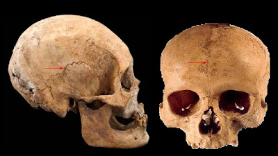 La unión de los huesos se produce por tejido fibroso. Las articulaciones de los huesos del cráneo y de la cara son ejemplos de suturas o sinostosis.