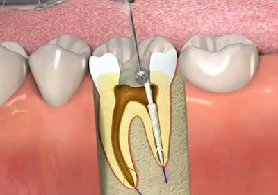 Lấy tủy răng có ảnh hưởng gì không?