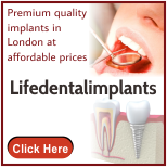 Cheap Dental Implants