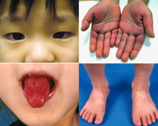 Kawasaki Disease: Causes, Diagnosis and Treatments