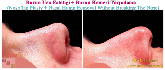 Rhinoplasty Without Breaking Nasal Bone - Rhinoplasty Without Breaking Nasal Bone - Female Nose Aesthetic Surgery - Nose Jobs For Women - Nose Reshaping for Women - Female Rhinoplasty Istanbul - Nose Job Surgery for Women - Women's Rhinoplasty - Nose Aesthetic Surgery For Women - Female Rhinoplasty Surgery in Istanbul - Female Rhinoplasty Surgery in Turkey