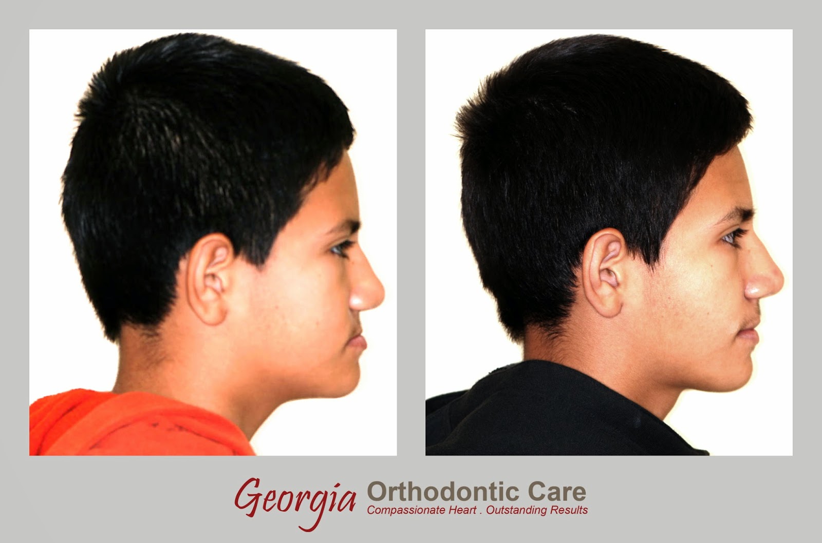 Facial profile, Under bite treatment, class III treatment, Lawrenceville orthodontist, Norcross orthodontist, Gwinnett orthodontist, orthodontists, orthodontics, under bite, over bite, Georgia Orthodontic Care, Dr Nguyen, Cosmetic, Implant, Children, Family, Dentists, Clear, Braces, Invisible, Adults, Teens, Children, Clear Braces, Invisible Braces, Invisalign, Straighten, Teeth, Lawrenceville, Norcross, Buford, Hamilton Mill, Dacula, Auburn, Sugar Hill, Sugar Loaf, Doraville, Chamblee, Stone Mountain, Decatur, Collins Hill, Snellville, Suwanee, Grayson, Lilburn, Duluth, Cumming, Alpharetta, Marietta, Dekalb County, Gwinnett County, Atlanta, North Georgia, GA, Georgia, 30043, 30093