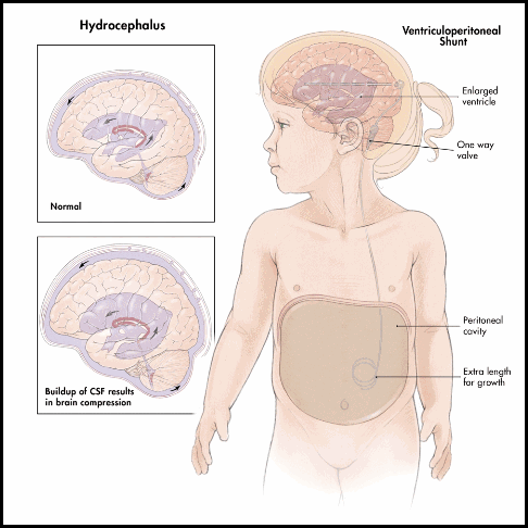 Final_Hydrocephalus_medical show